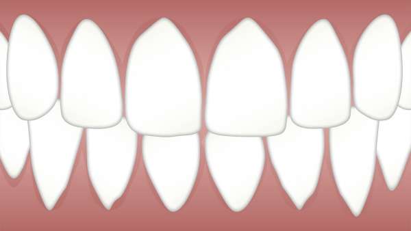 Periodontitis