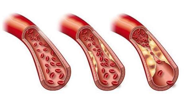 High Triglycerides