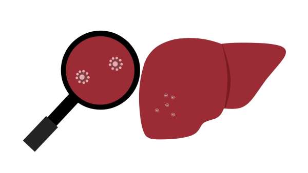 Hepatic steatosis