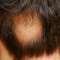 Hair loss – what it is and how it can be treated with natural remedies